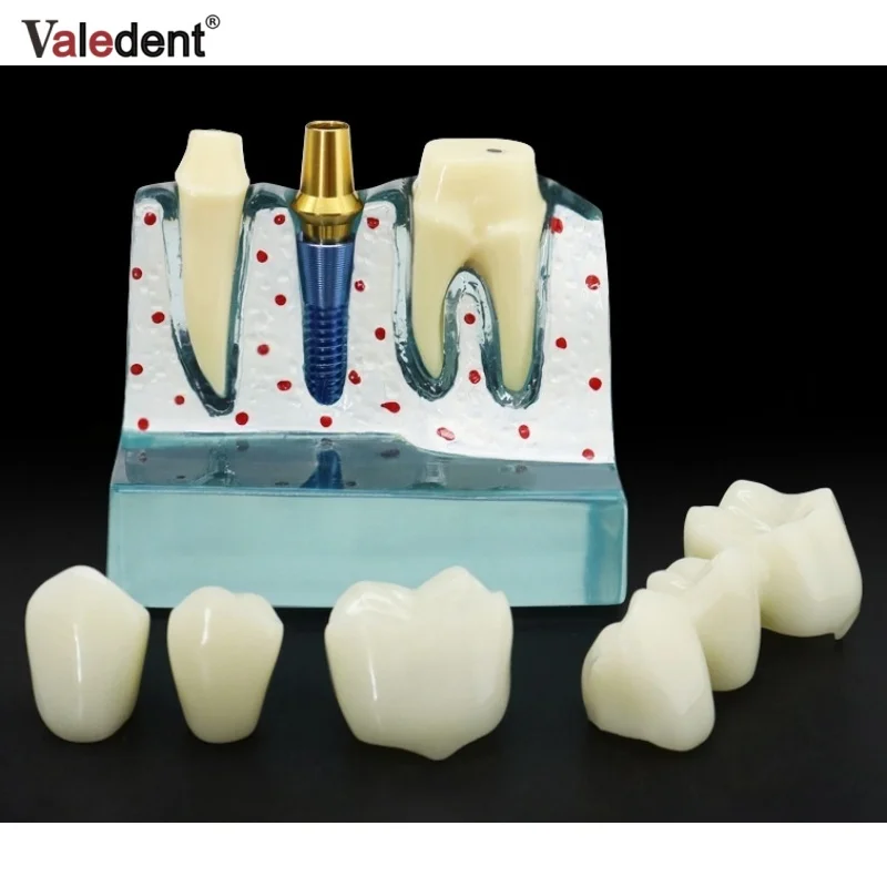 Dental Implant Model Magnified Caries Contrast Tooth Model Crown Dental Implant Models for Doctor-patient Communication