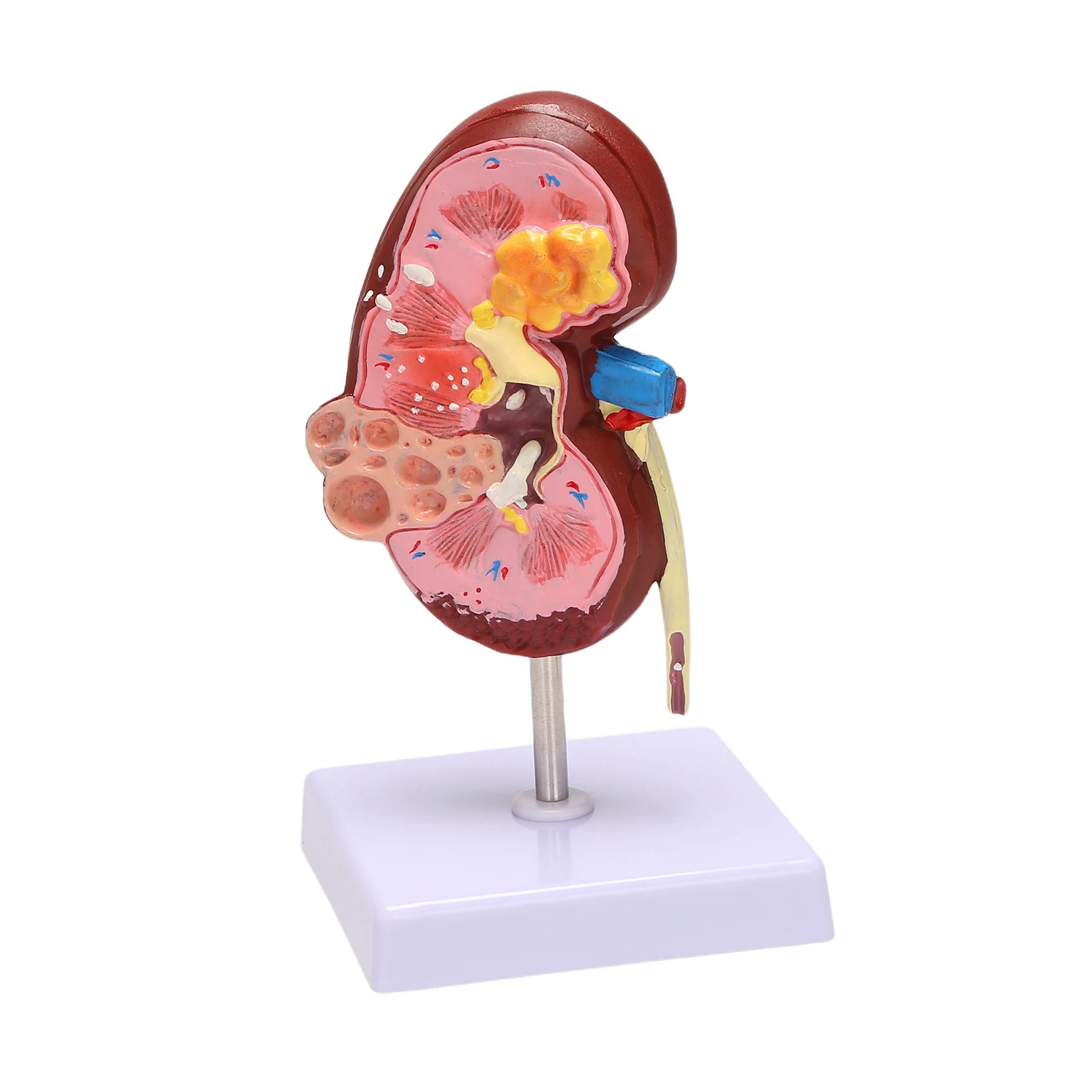 Kidney Pathologies Model Human Body Anatomy Replica of Diseased Kidney for Doctors Office Educational Tool Anatomicals