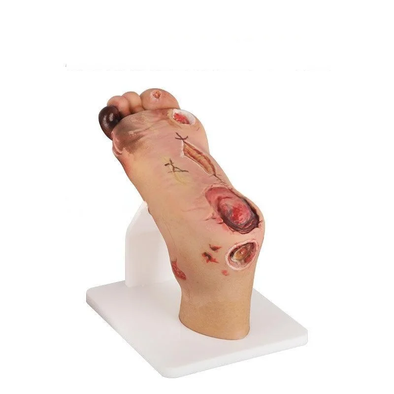 Diabetic foot model (mild/severe) teaching equipment for medical training and education, preventive diabetic foot model