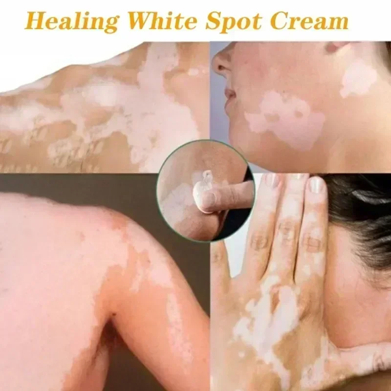 Creme para manchas brancas para vitiligo, manchas brancas, leucoplasia, pigmentação, melanina, promovendo creme de vitiligo, cuidados com a pele