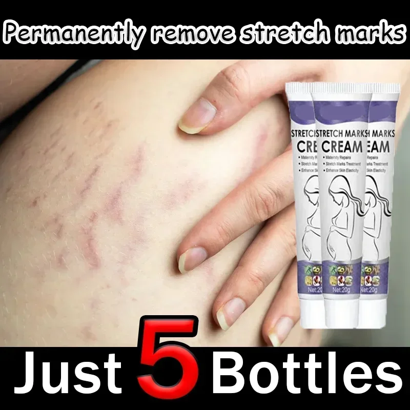 Eliminate Red White Old Stretch Marks Cream For Pregnancy Postpartum Skin Care Gel