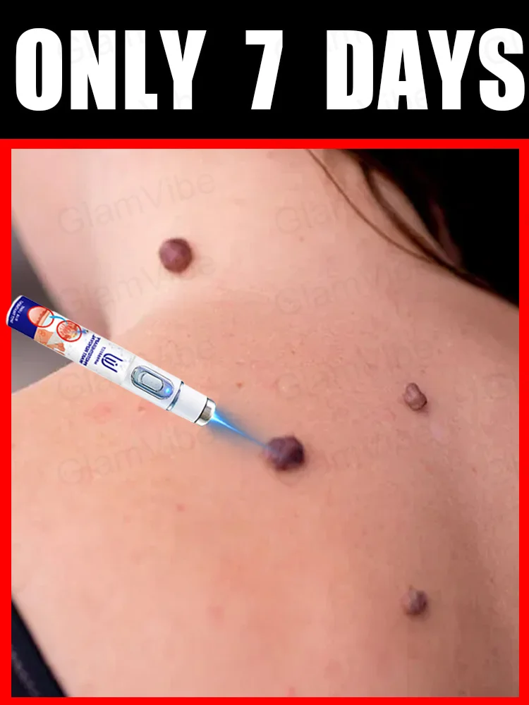 

blue light pen solve warts, hot sale wart care tools