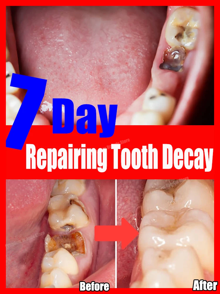 

Decay tooth cavities healing anti caries