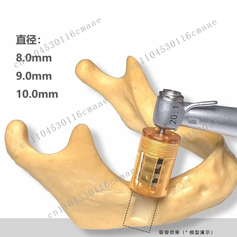 신제품 기타 장비 외과 기구 이지 세미루나 뼈 쉘 콜렉터 8.0mm 9.0mm 10.0mm 정형외과 드릴