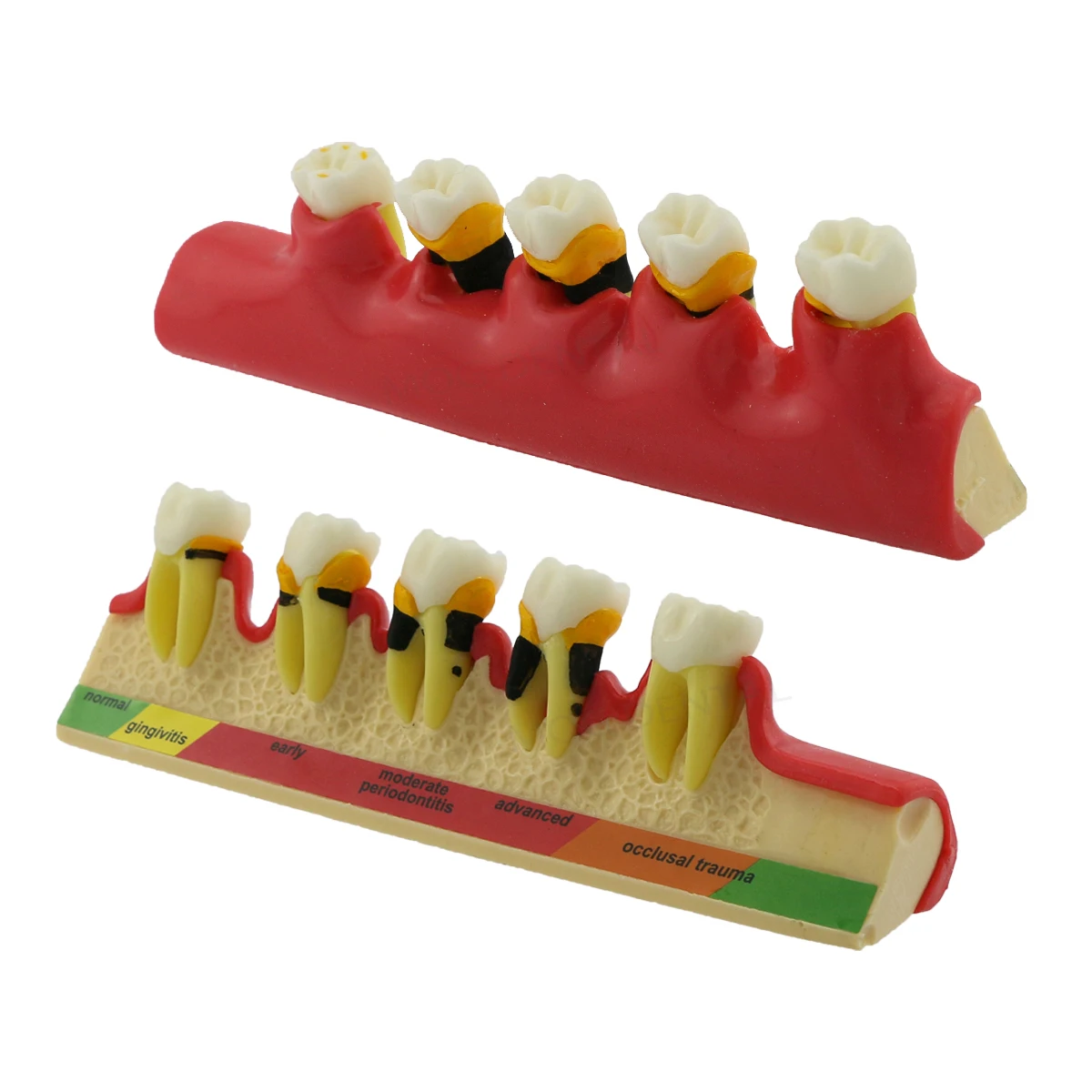 Dental Model Teeth with Periodontal Disease Dental Education Model Display Caries Periodontitis for Medical Teaching Study