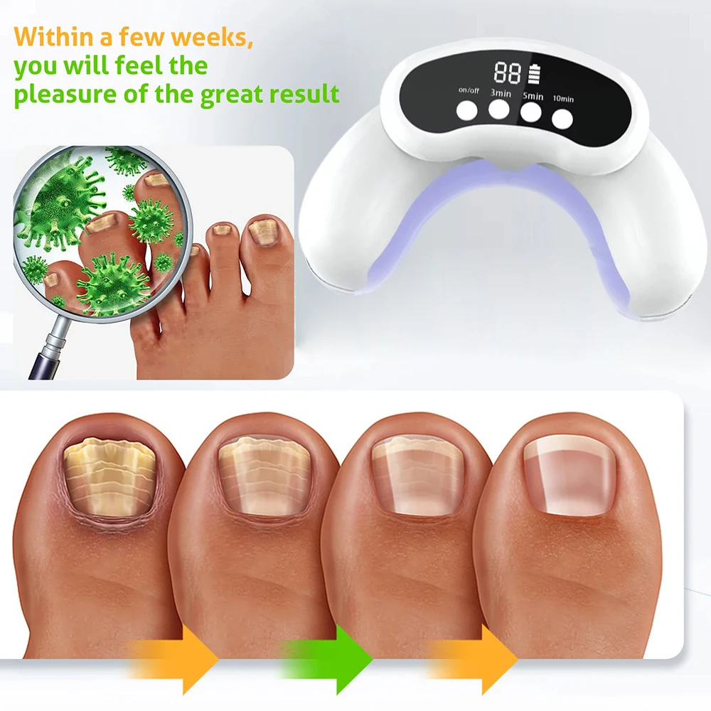 Nail Fungus Cleaning Laser Device For Multiple Toenail Repair Fast Nails Fungus Onychomycosis Removes Ingrown Toenail Treatment