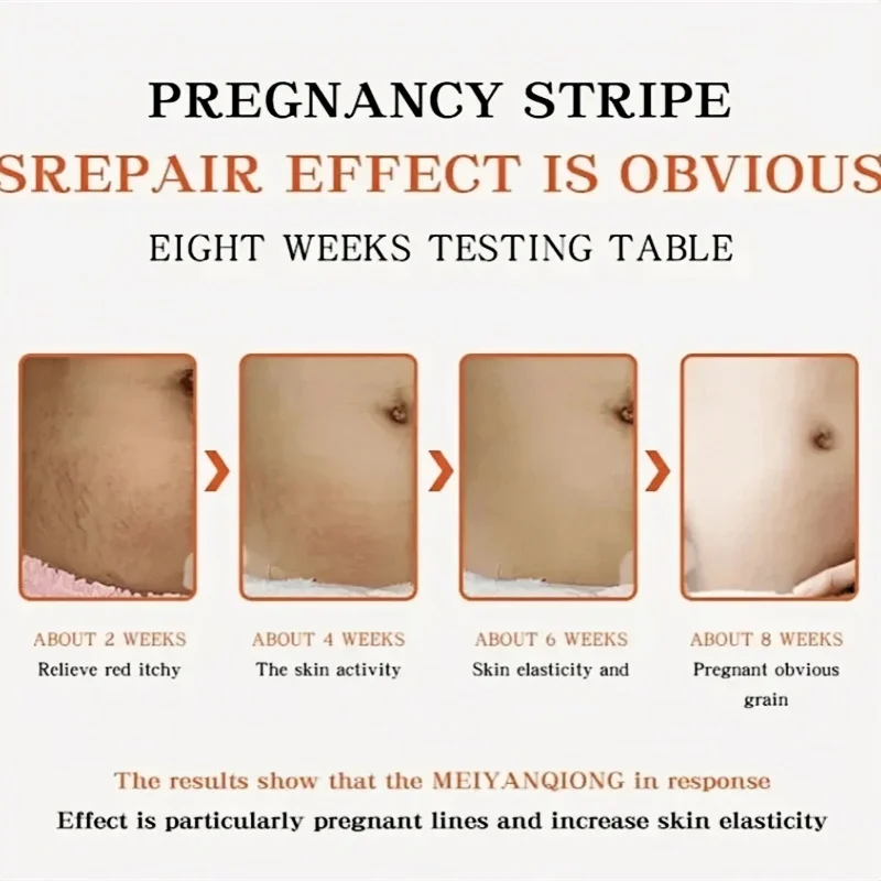 Crema de eliminación permanente de estrías, maternidad, mujeres embarazadas, embarazo, antiarrugas, reparación suave, reafirmante de la piel, cuidado de la piel corporal