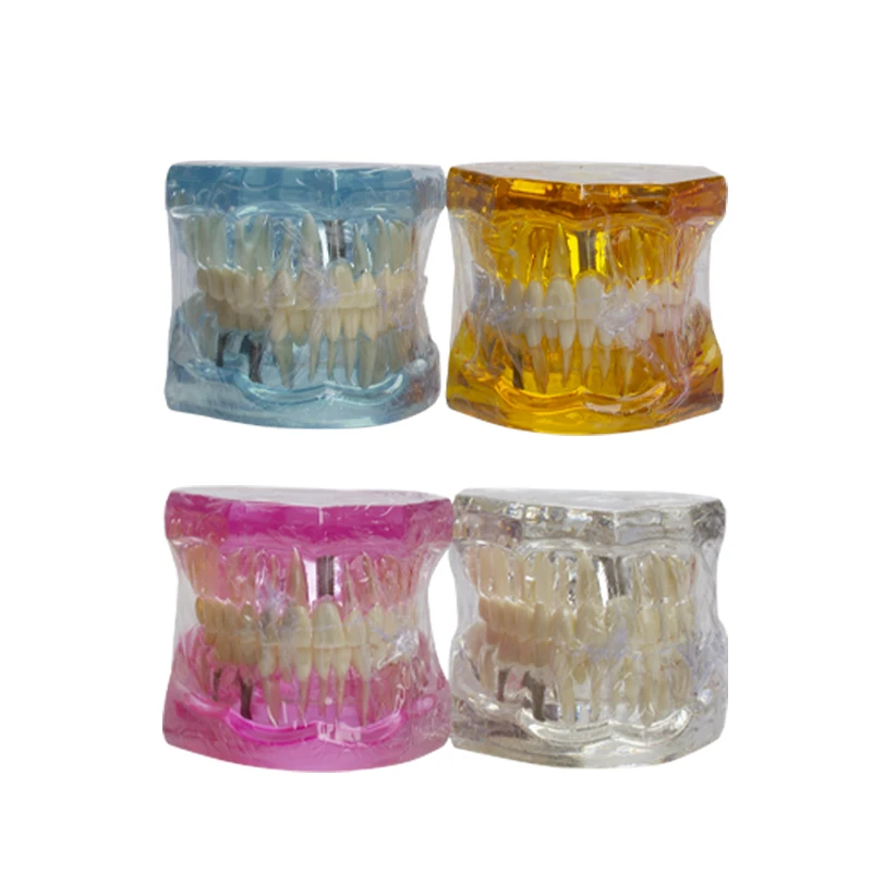 Removable multi pathology model transparent resin jawbone model, displaying the root canal condition of dental caries in implant