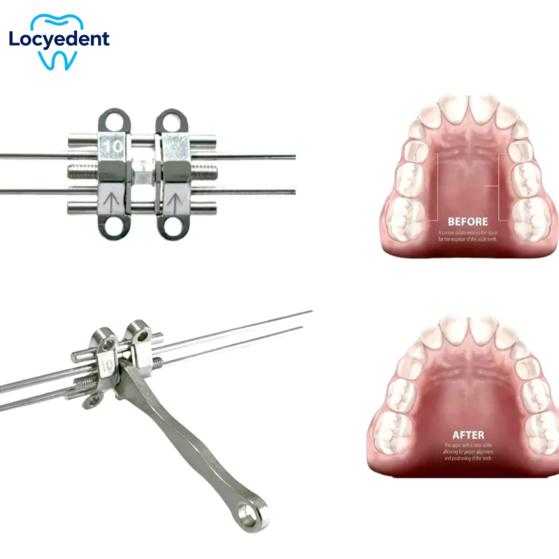 Tornillo de expansión de ortodoncia Dental, expansor de hueso MSE BMK, mango en espiral antiagüe, sistema de anclaje temporal, implantes de mandril, 1 ud.