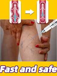 Laser therapy VARICOSE VEINS Improved blood circulation