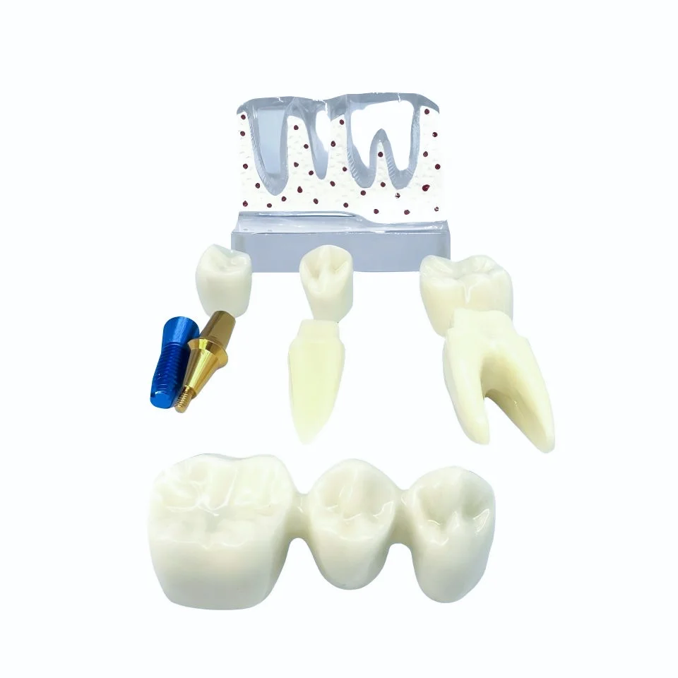 Clear Dental Implant Disease Model Removable Tooth Bridge Abutment Implant Fixture Screw for Patient ConsultationStudentTraining