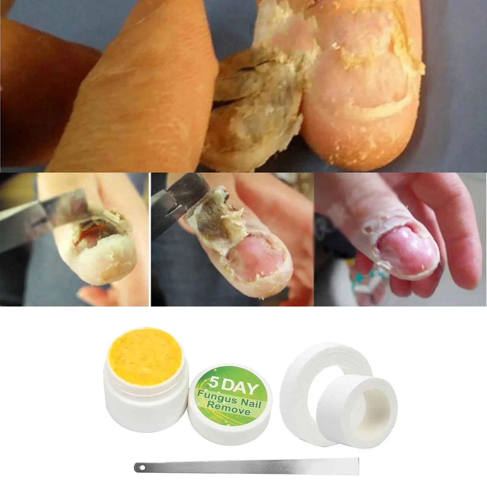 20g Anti Fungus Nail Fungus Treatment Cream Paronychia Anti Fungal Nail Treatments Nail Repair Liquid Foot Care Tools