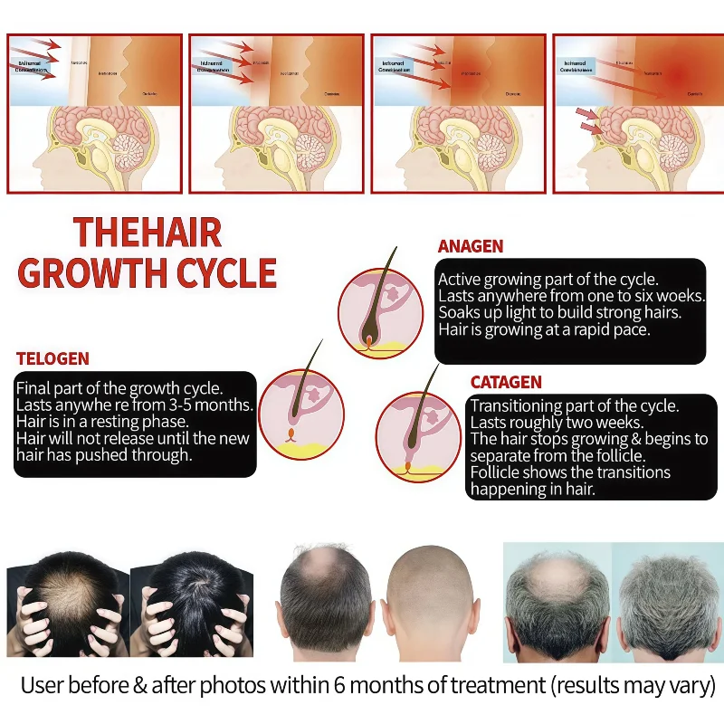 

Кепка для терапии красным светом 2025, 650 нм, безопасный лазерный шлем для восстановления волос с функцией массажа кожи головы
