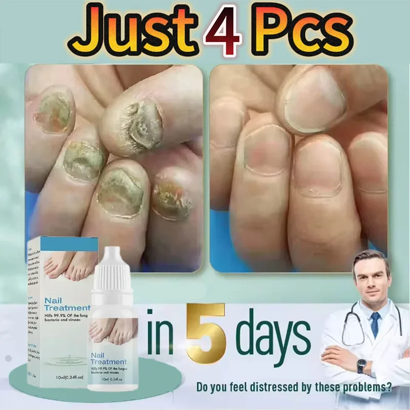 New Nail Fungus Treatment For Toenail Strength Repair Solution Hydrates Renew Damaged Discolored Foot