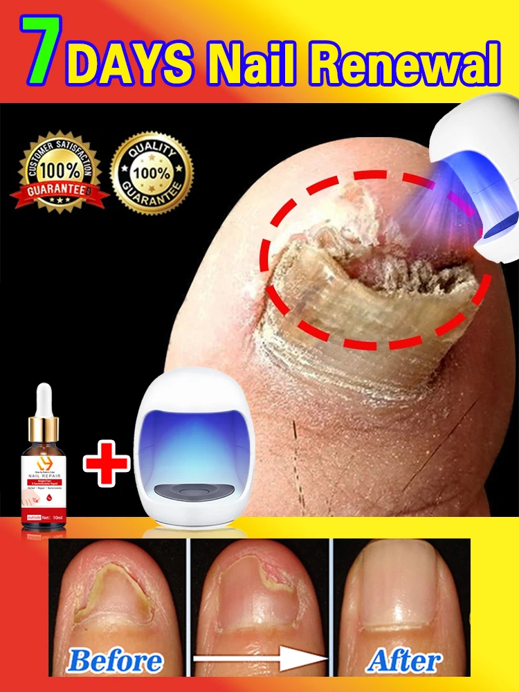 Laser Product To Solves Nails troubles