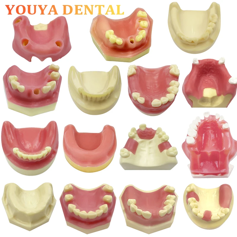 

Dental Implant Model Upper and Lower Jaw Soft Tooth Implant Model Dental Internship Student Oral Research Teaching Mode