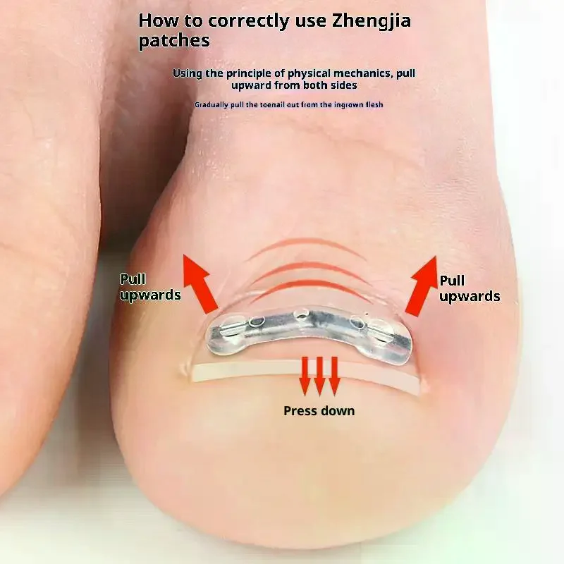 Werkzeuge zur Korrektur eingewachsener Zehennägel, Pediküre, Wiederherstellung, Einbettung der Zehennägel, professionelle Clip-Klammer zur Glättung eingewachsener Zehennägel