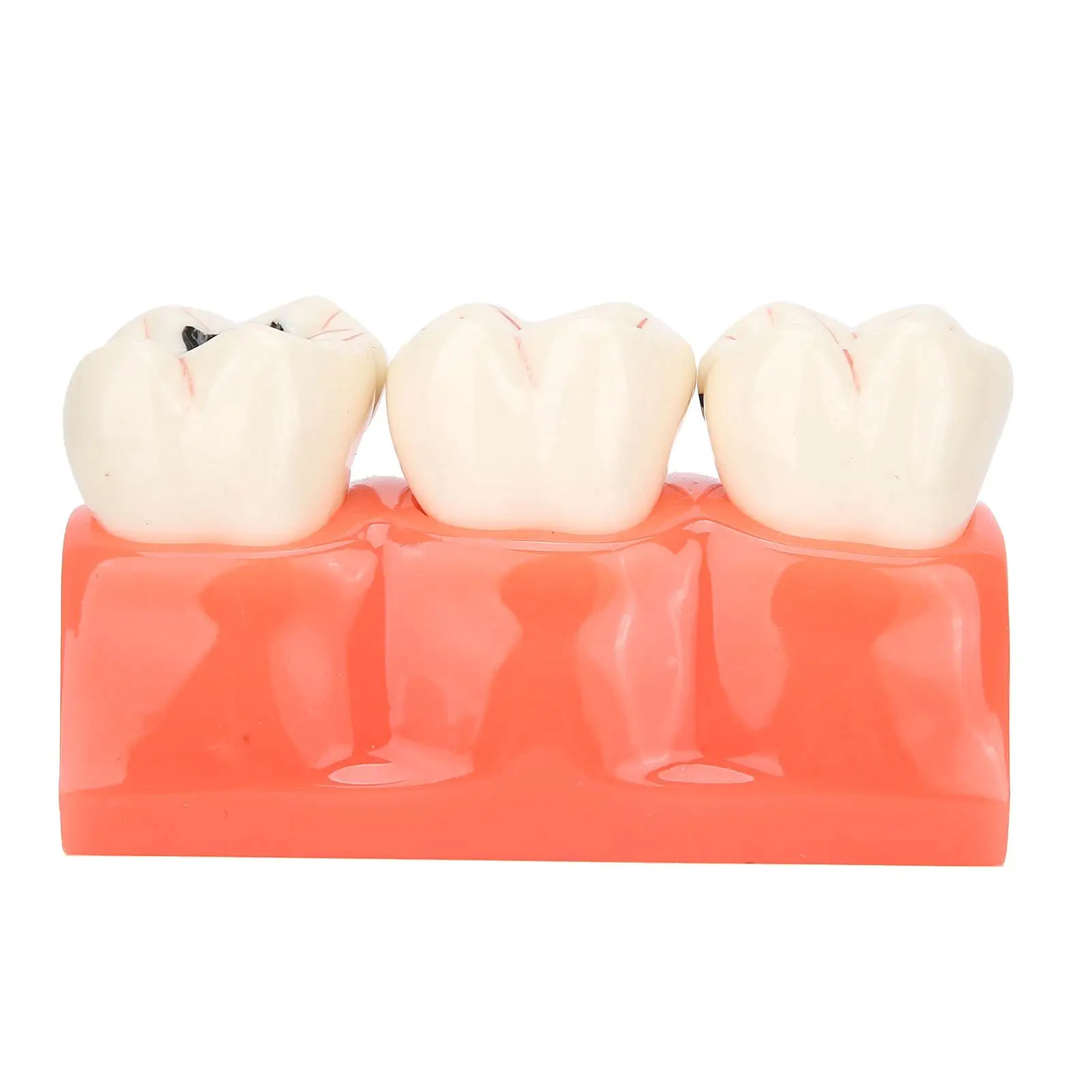 

Dentistry Caries Model Tooth Decay Demonstration Simulation Dental Teeth