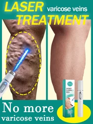 Blue Laser Heals Leg Veins