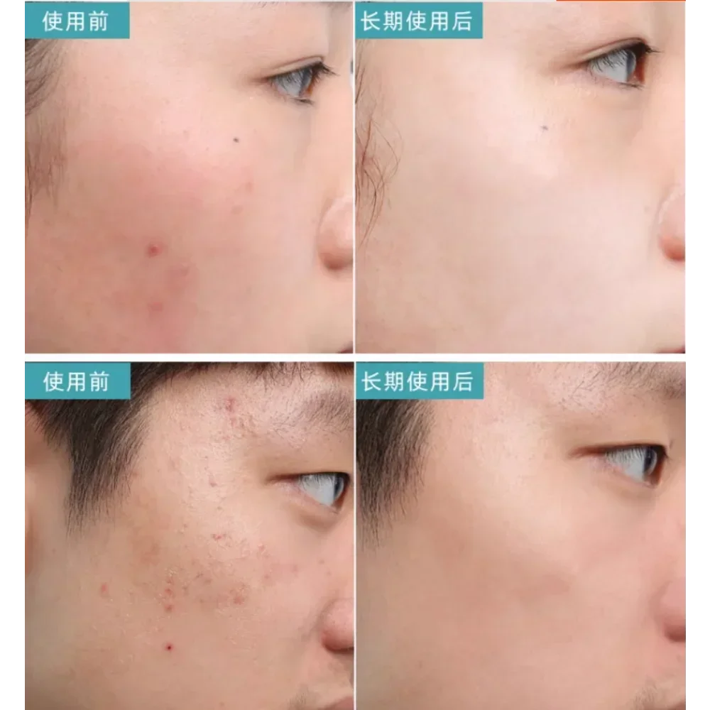 D18 oligopeptídeo purificar reparação soro clarificando óleo equilíbrio reparação facial desaparecer marcas de acne remover cravos coreia cuidados com a pele