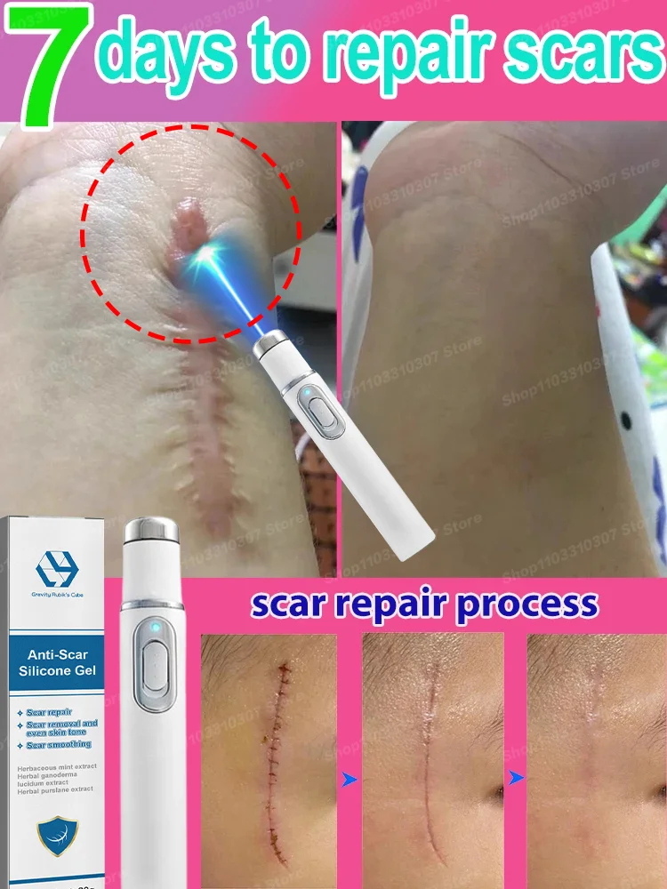 

Laser Repair Skin Scars