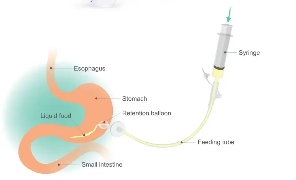 Percutaneous Endoscopic Gastrostomy Kit of skin puncture technology and flexible endoscope ﻿gastric decompression