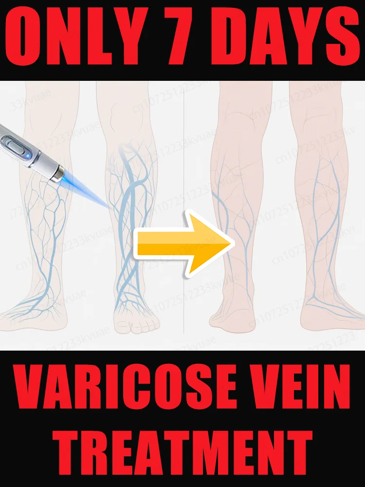 

Generation-2 Laser Says Goodbye To Spider Legs Varicose In 7 Days