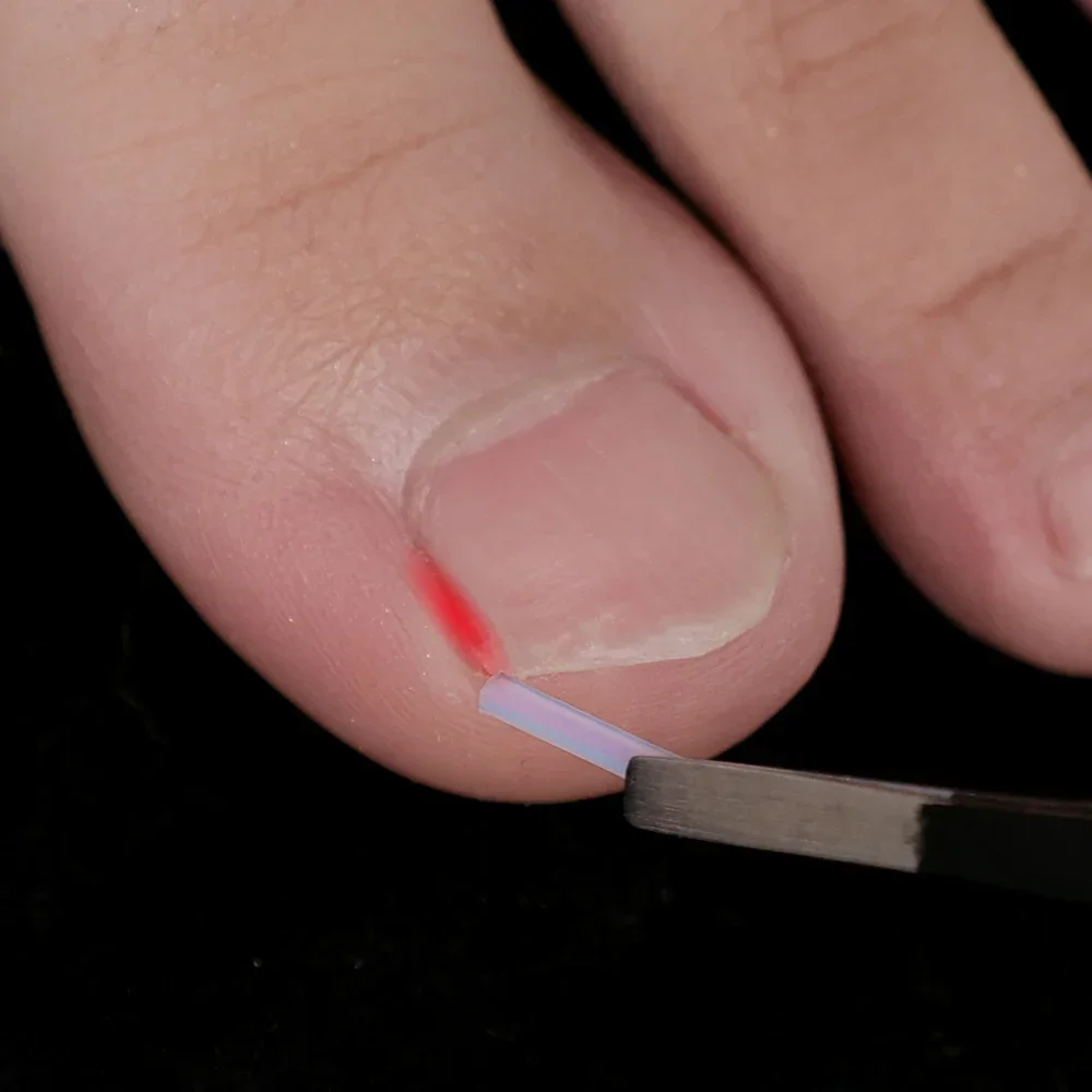 Ingrown Toenail Correção Tiras, Tubo elástico em forma de C Pad, Endireitando Clipes, Paroníquia Correção Toe Nail Tratamento Strip