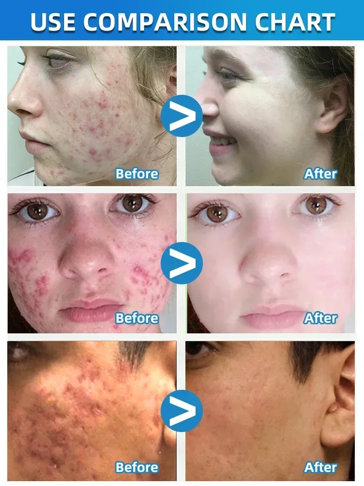 Ervas-acne tratamento rosto soro, espinhas removedor, encolher poros, controle de óleo, cuidados com a pele