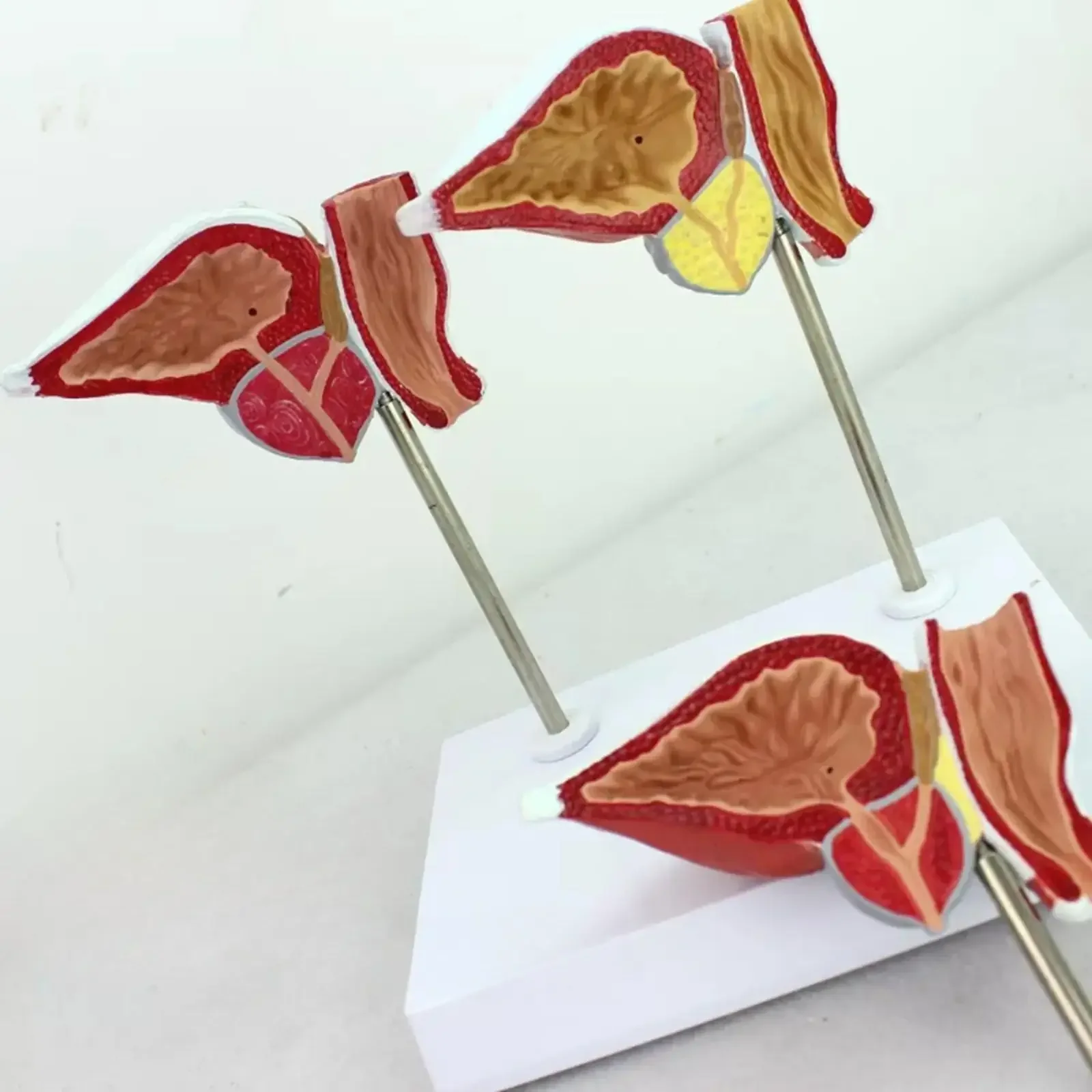 PVC Human Prostate Normal Hyperplasia Carcinoma Model Medical Teaching Models