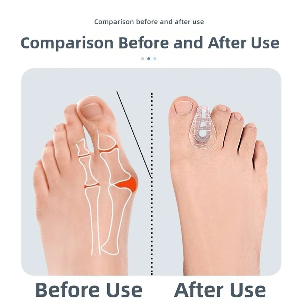 2 قطعة فاصل تداخل أصابع القدم شفافة SEBS فاصل أصابع القدم لملحقات مصحح الورم لتقويم العظام