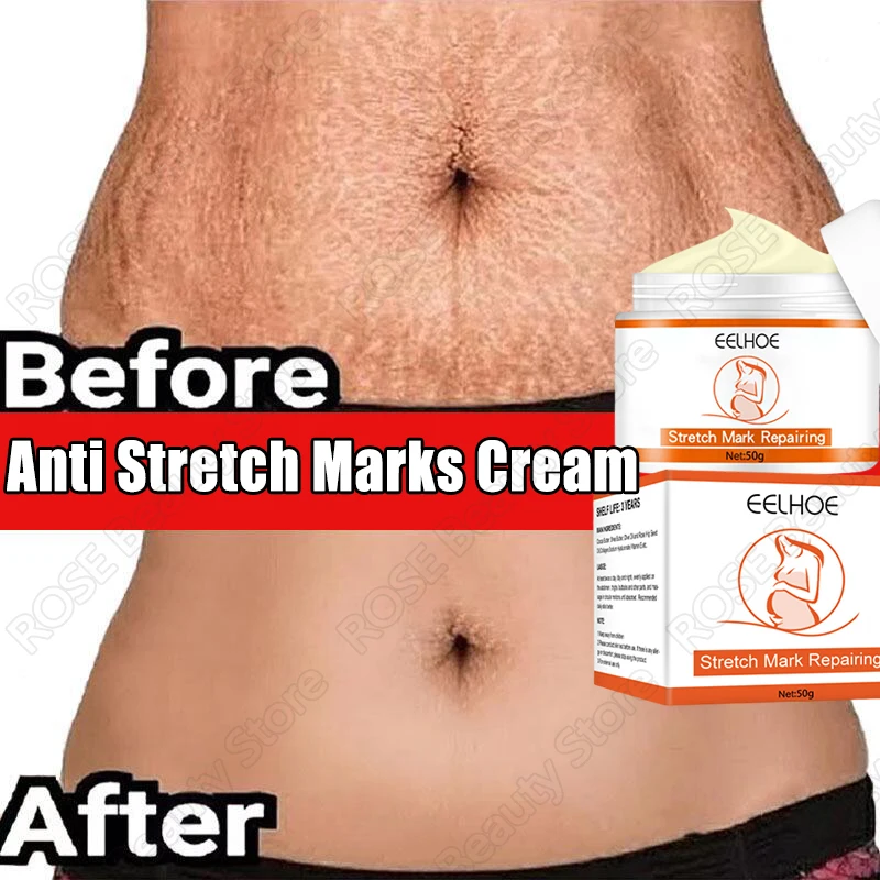 Anti Stretch Marks Cream Removal Stretch Mark Remove Postpartum Obesity Pregnant Stretch Mark Lotion Women Repair Firming 50g