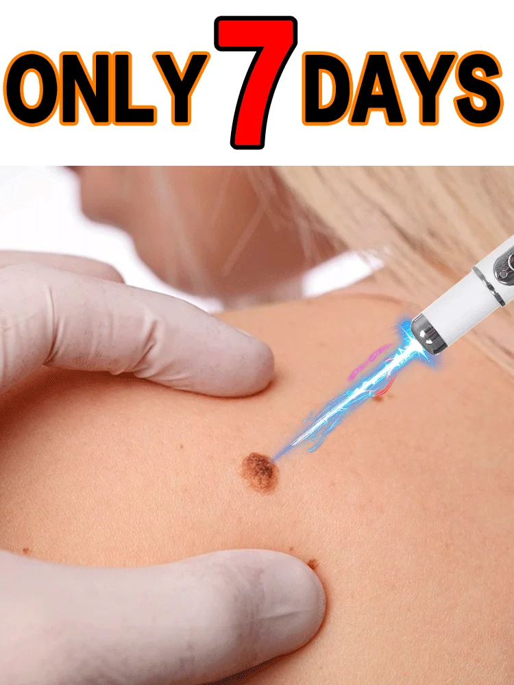 

blue light pen solve warts, hot sale wart care tools