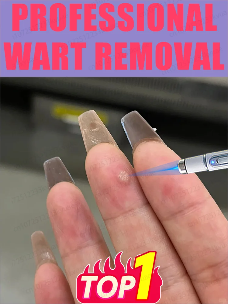 ᴸᵃˢᵉʳ ᵖᵉⁿ ᵃᶜᶜᵘʳᵃᵗᵉˡʸ ʳᵉᵐᵒᵛᵉˢ warts without scarring or recurrence