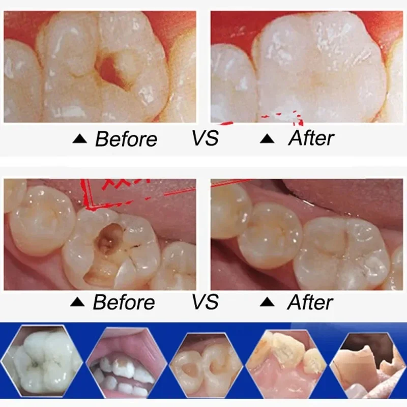 Imagem -04 - Dentes Dentais Cola Cimento Faça Você Mesmo Kit de Reparação Quebrado Dente Dentadura Furo de Enchimento Gem Aparelhos de Prótese Falsa Resina Adesiva Profissional