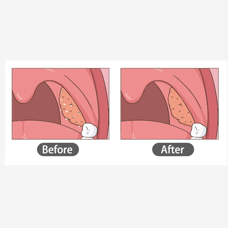 Kit de eliminación al vacío de piedra de Tonsil electrónico, cuidado bucal, herramientas de succión instantánea, mejora la salud 0ral