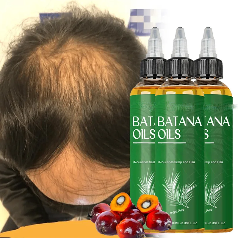 

Batana Hair Oil Repairing Damage Strengthening Massage Nourishment Reduce Loss Improve Dryness Scalp T-Reatment Hair Growth Oils
