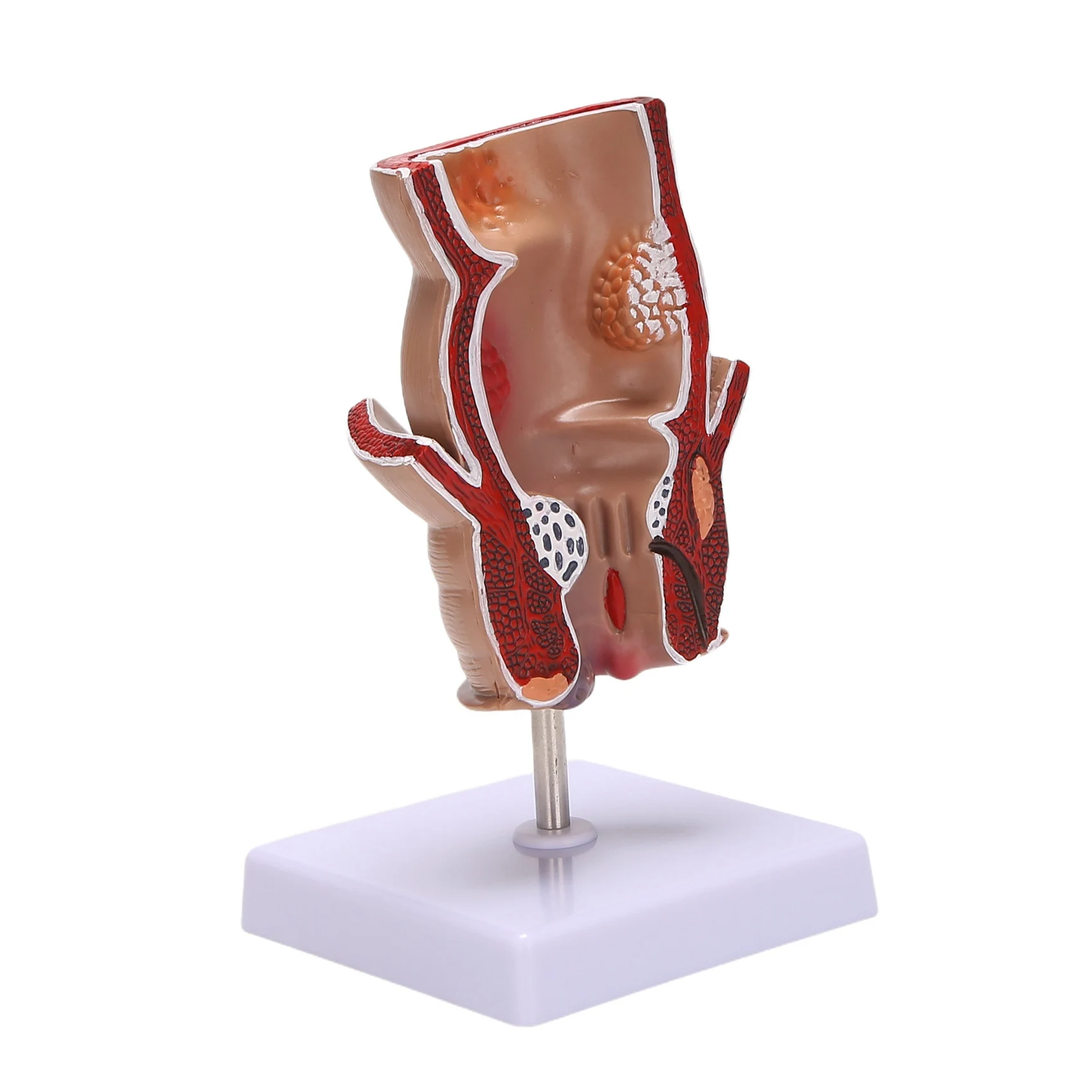 

Anatomy Model Human Rectal Lesion Model Fistula Fistula Fissure Pathology Teaching Model