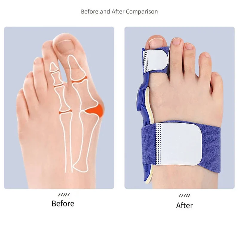 Attelle d'Oignon Réglable, Protecteur de Pied, Redresseur Hallux Valgus, 1 à 2 Pièces