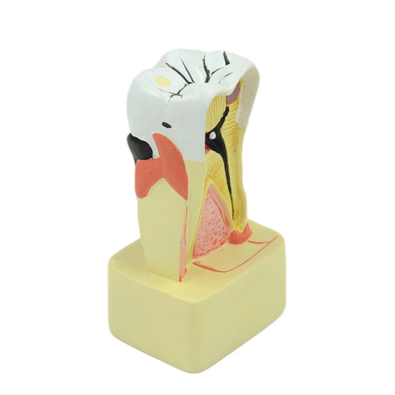 

Dental Pathology Teeth Model Periodontal Model PVC for Dentist Teaching Student Study Medical Science Y3NC