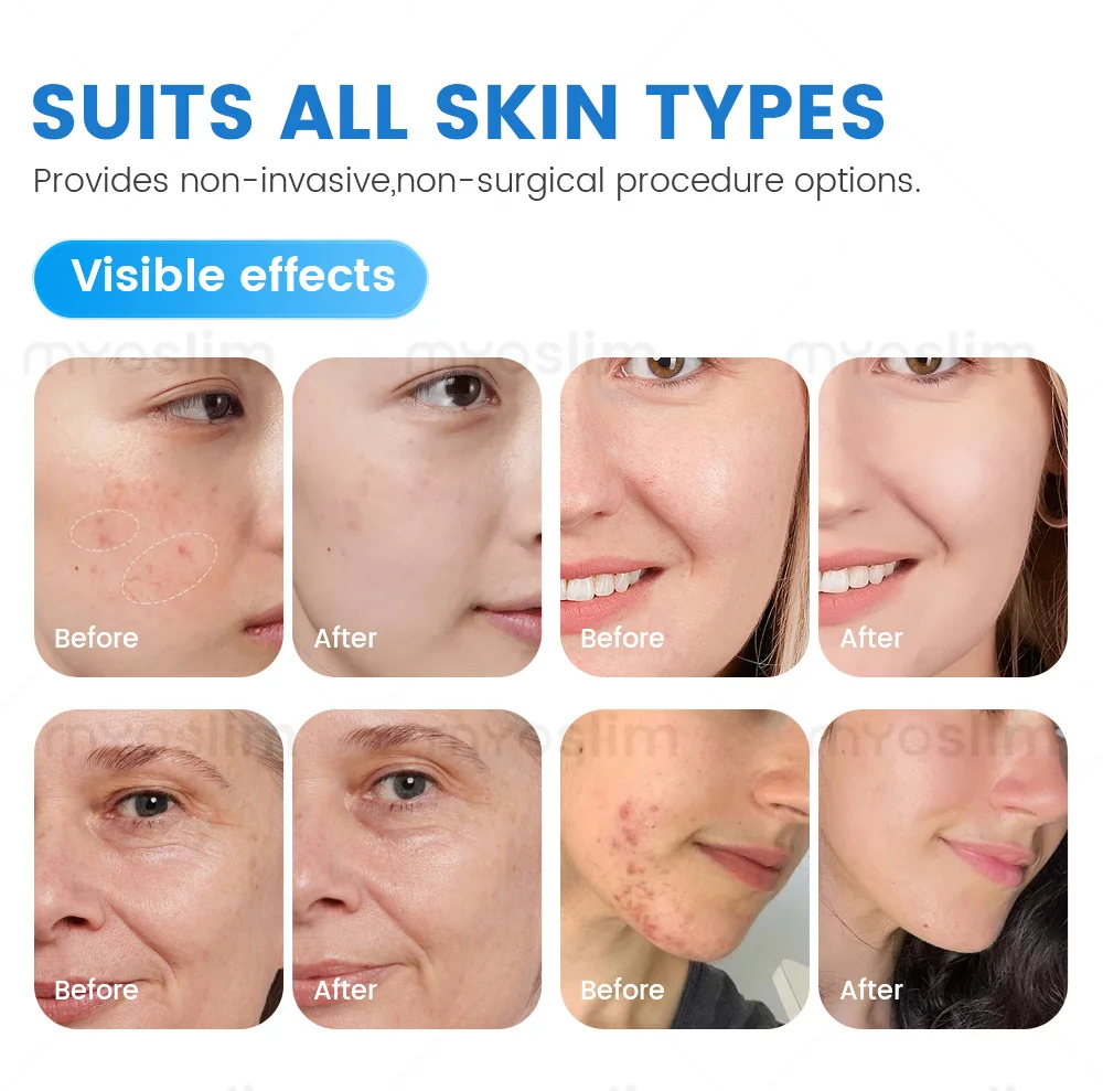 Mesin Hydro Dermabrasion 7 in 1 Terbaru untuk Facial Aqua Peel, Mesin Mikrodermabrasi, Peremajaan Kulit