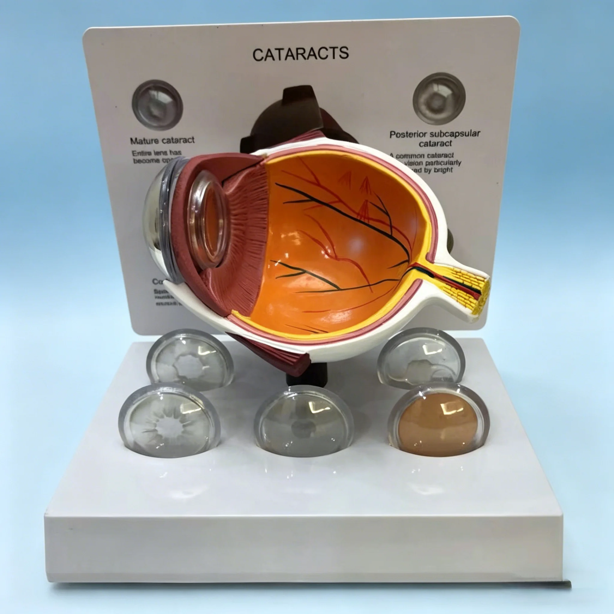 Cataract Explaination Model Shows Cornea, iris, lens, and vitreous body | Education Eyeball Model | Eye Anatomical Model