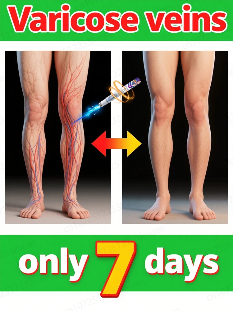 

Generation-2 Laser Says Goodbye To Spider Legs Varicose In 7 Days