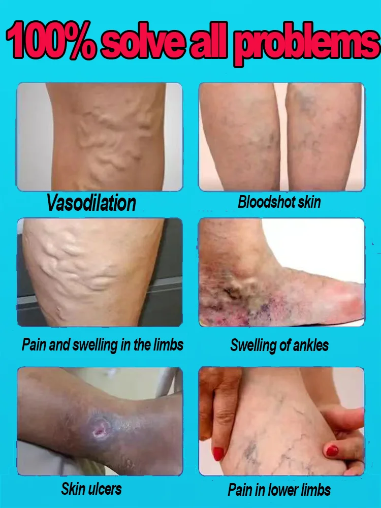 Veines laser de connaissance chaudes