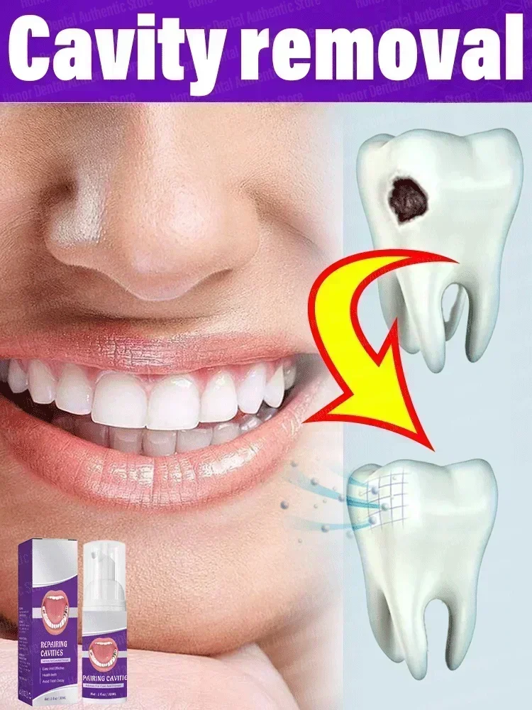 Effective Teeth Whitening Tooth decay repair  Calculus Plaque Periodontitis Remove Cavities