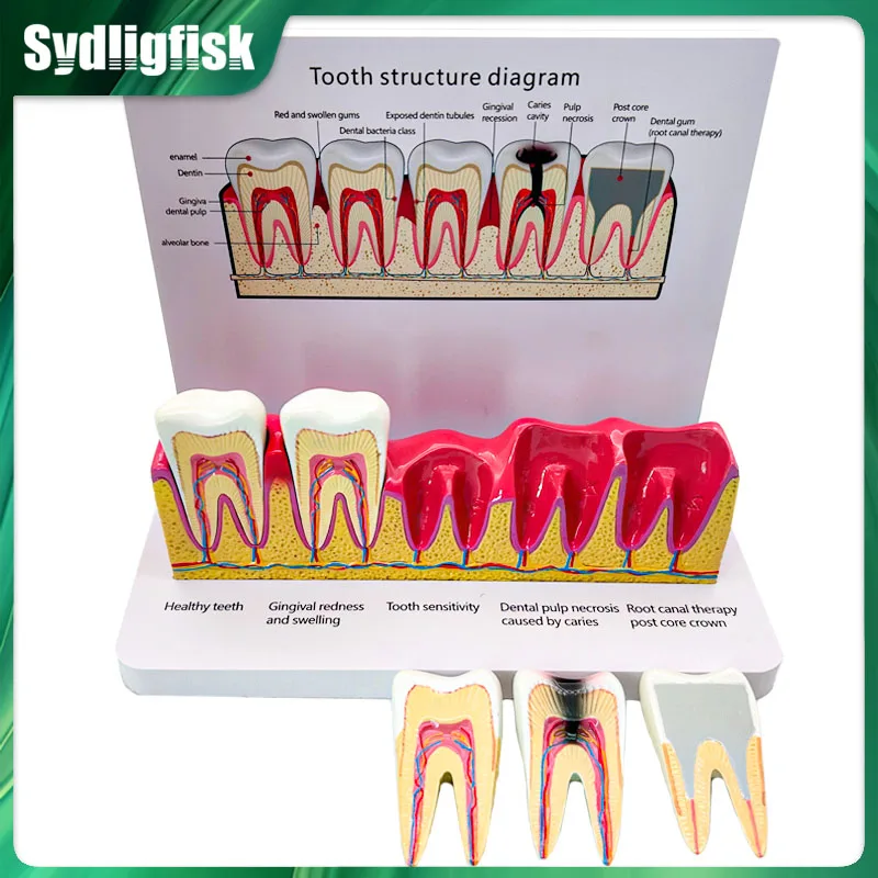 

Анатомическая модель стоматологической структуры зуба для обучения, изучения и практики, демонстрационная модель для врачей и пациентов, модель для стоматологов.