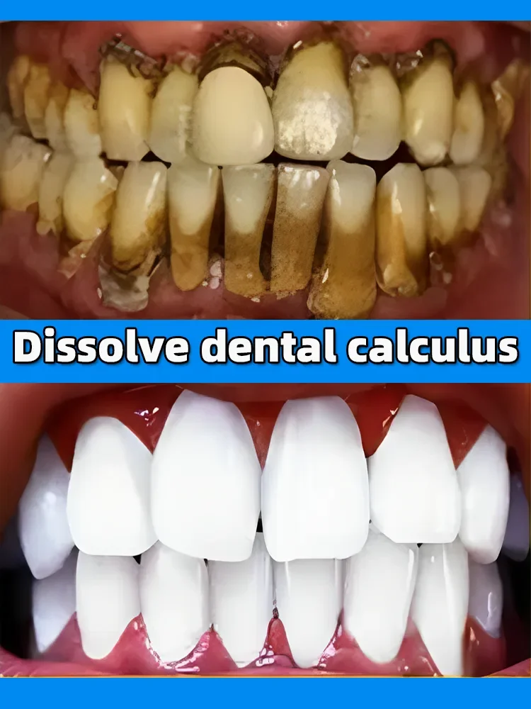 Rimozione del tartaro dentale sbiancamento dei denti rimozione del dentifricio alitosi schiarente prevenzione della parodontite cura della pulizia dentale