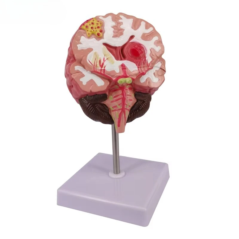 Human Brain Anatomy Model with Lesions (stroke, Subdural Hematoma, Migraine) - PVC Material