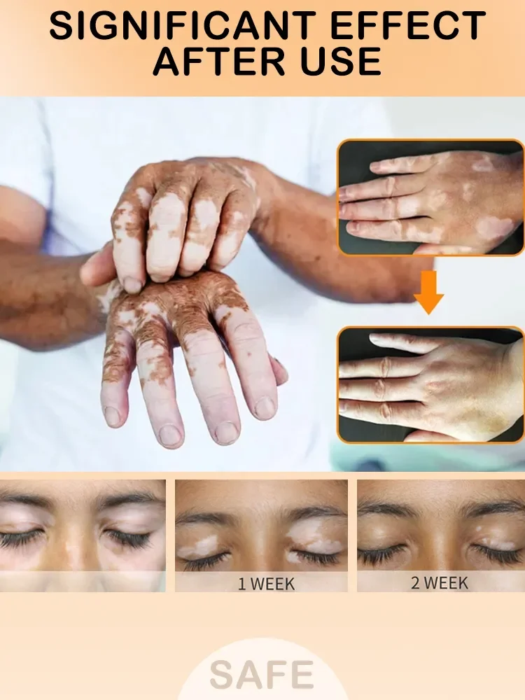 Vitiligo белый точечный крем для роста меланина