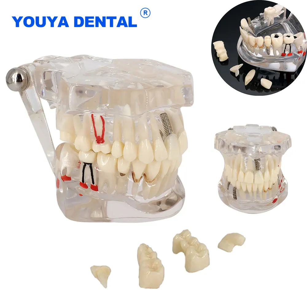 Dental Transparent Disease Removable Teeth Model With Restoration Bridge for Dentist Student Practice Teaching Study Medical